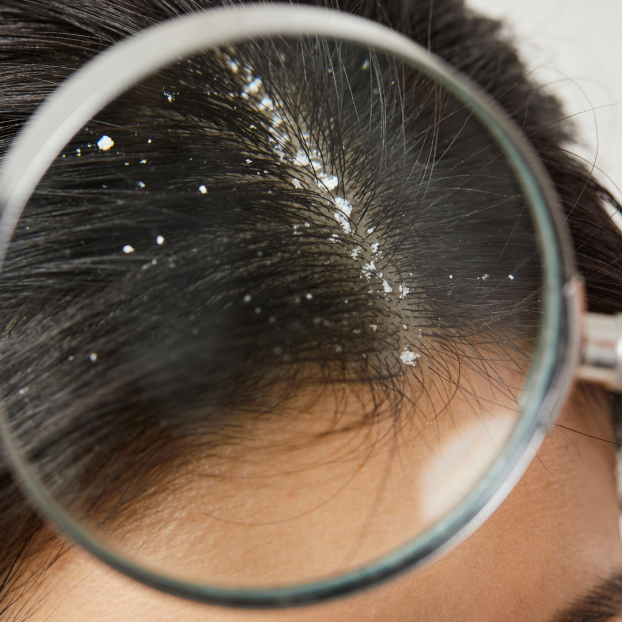 Scalp Inflammation & Oxidative Stress